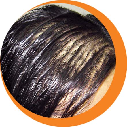 How to treat oily scalp Hair Problems