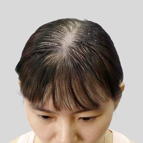 Female hair loss