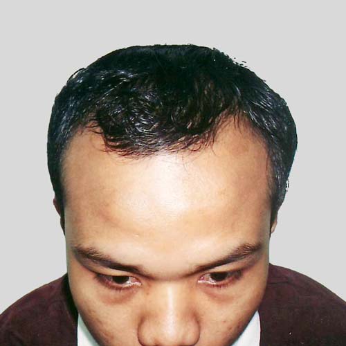 M shape hairloss