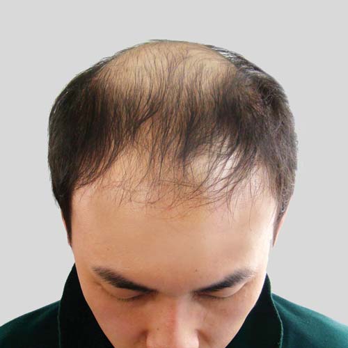 O Shape men hairloss