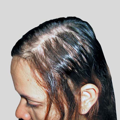 Oily Scalp