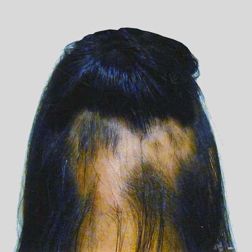 Ring shape hairloss