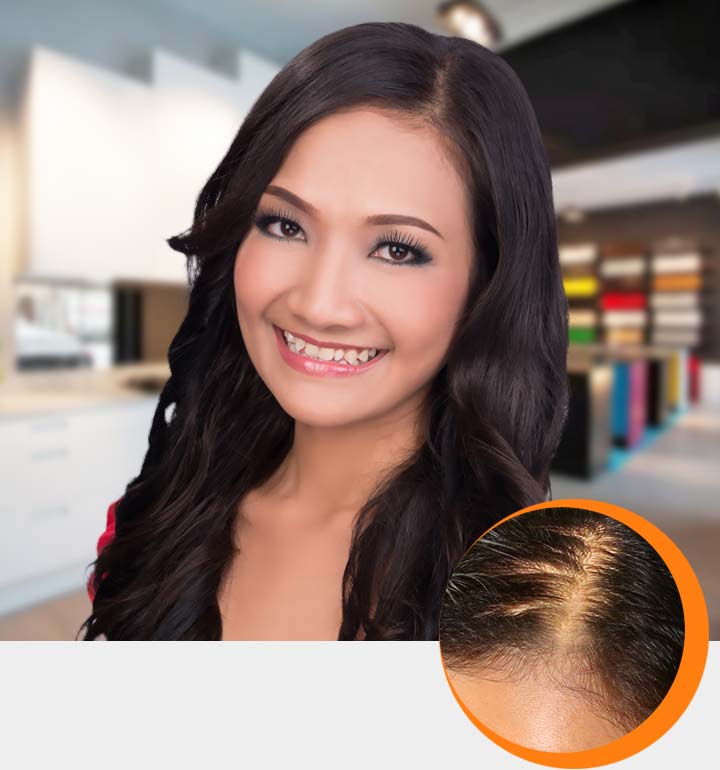 Masalah Rambut Keguguran Wanita