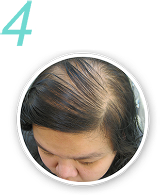 Dry Scalp, Imbalanced water and oil ratio at the scalp.