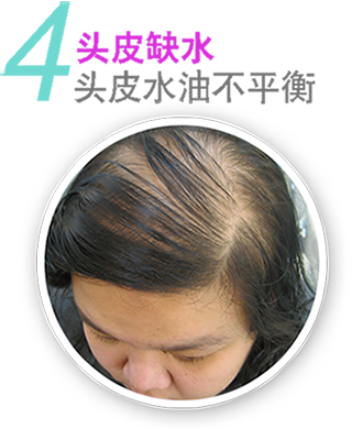 头皮缺水  头皮水油不平衡